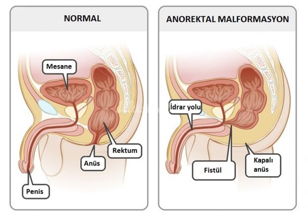 anorektalmalformasyonlar anorektal malformasyonlar