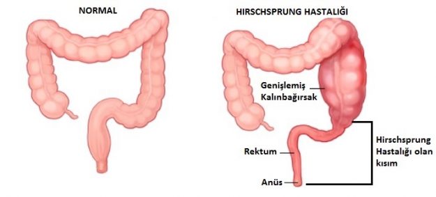 hirscsprung
