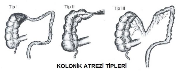 kolonikatrezi