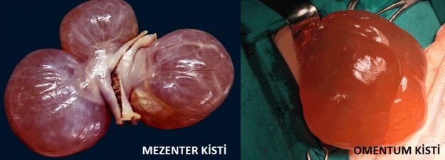 mezenterkisti